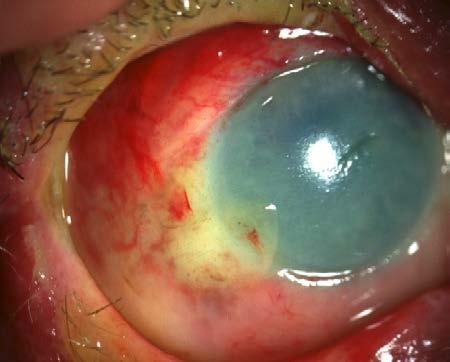 Chemical to eye Severity of alkali burn is judged by corneal opacification size of