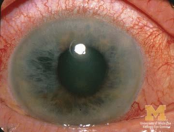Acute glaucoma Refer immediately Give any available pressurelowering