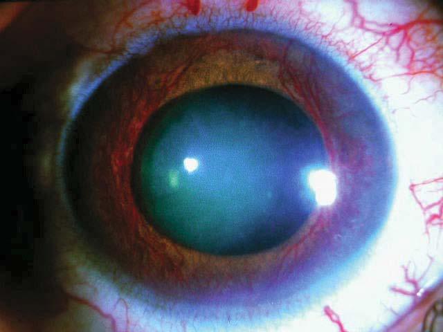 CC-fistula), perform lateral canthotomy/cantholysis Cut lateral eye