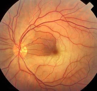 Central retinal artery occlusion Acute, painless loss of vision