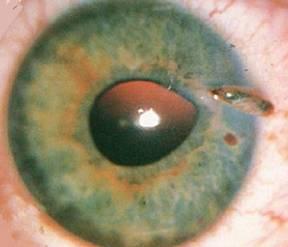 Ruptured globe Corneal or scleral full-thickness laceration Eye loses pressure and contents shift