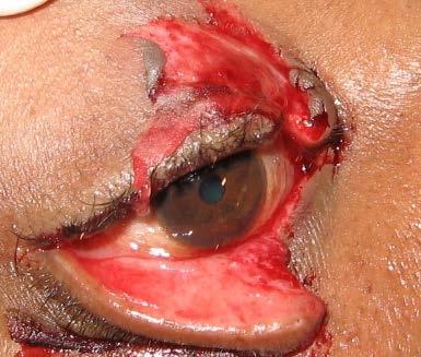 Eyelid lacerations Eyelid margin