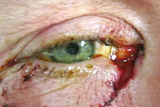 Eyelid lacerations Lacrimal canaliculus Suspect if laceration involves eyelid