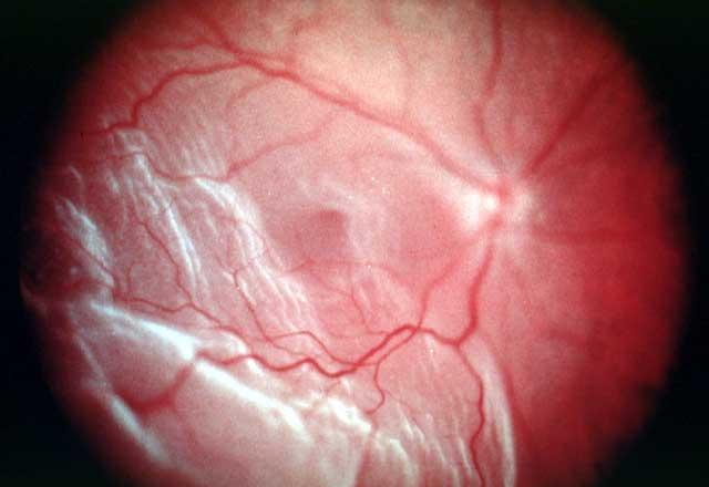 Retinal detachment Retina separates from back of eye wall Symptoms are