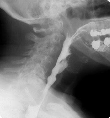Holding of saliva or food/fluid in the mouth Patient reports difficulty swallowing Video fluoroscopy is a radiological investigation which involves ingestion and attempted swallowing of a radioopaque