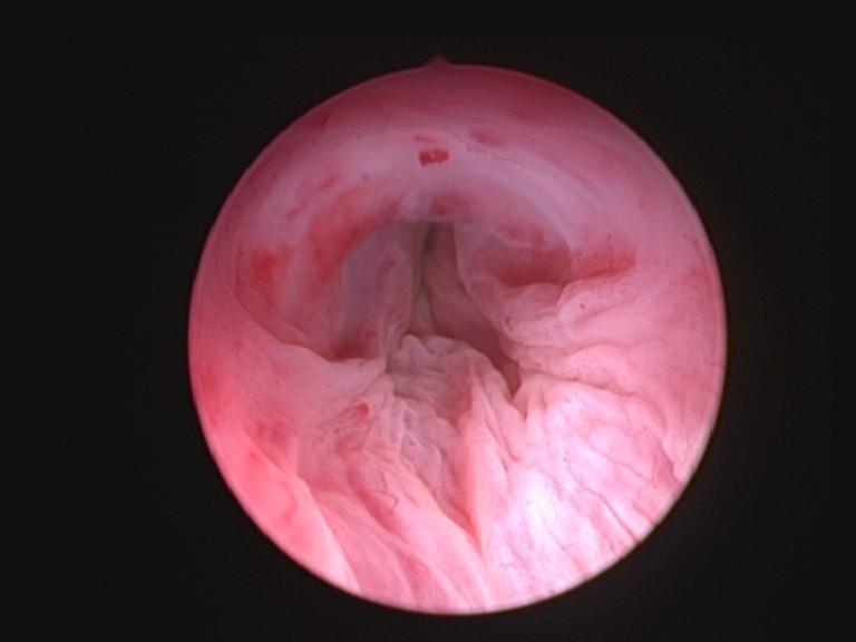 SUI in patients with sufficient and anatomically intact external urethral sphincter before prostatic