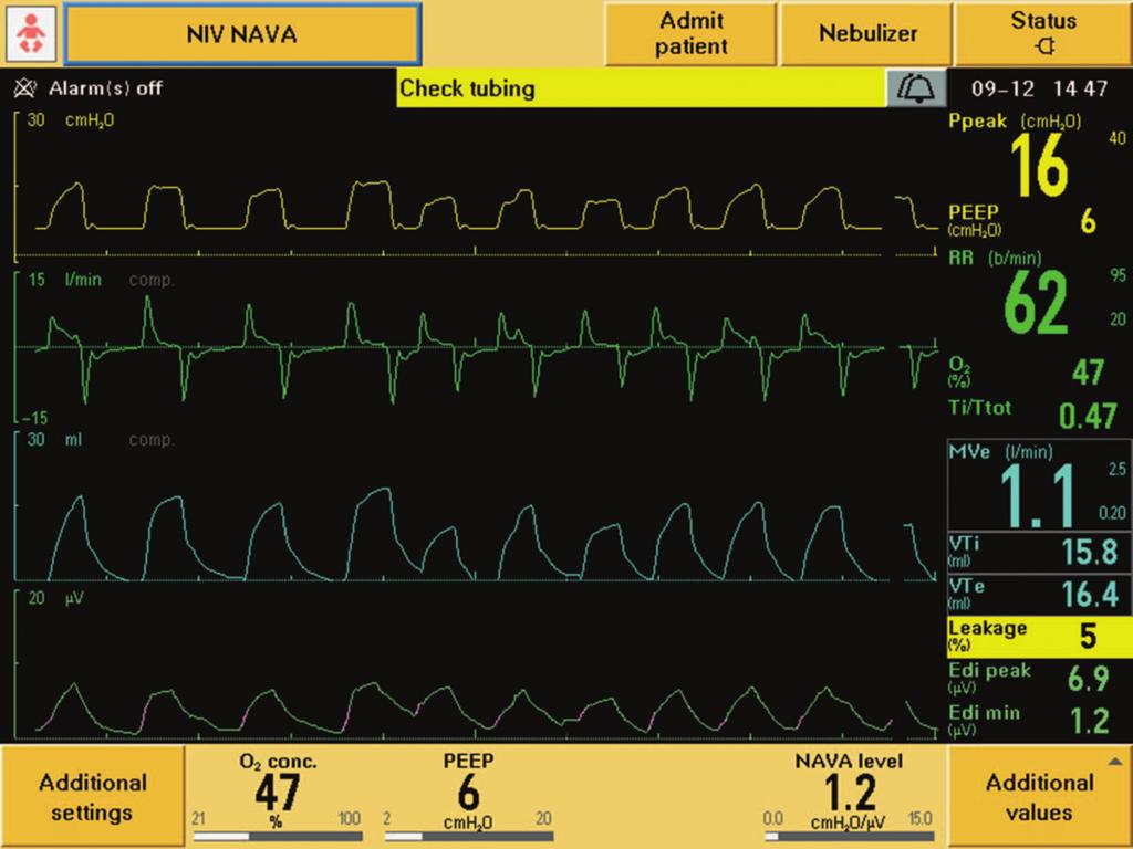 Fig. 4. Noninvasive ventilation-neurally adjusted ventilatory assist (NIV-NAVA) where each patient effort is captured.