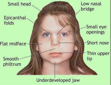 Fetal Alcohol Syndrome Low weight and height Poor coordination