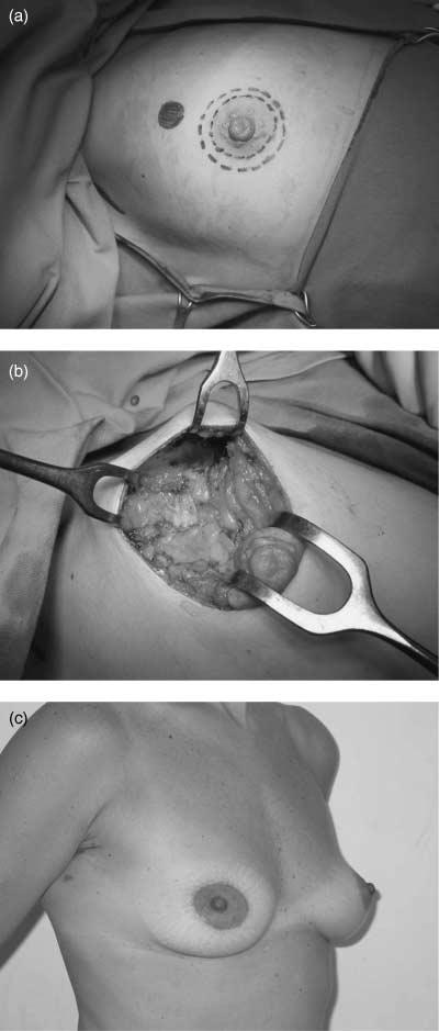 areola (Fig. 2b). The breast may be a little smaller than the opposite one, but the shape will be pleasant. If desired by the patient, nipple reconstruction can be performed at a later stage.