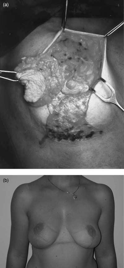 S178 masetti et al. the approach can be revised to a central lumpectomy (16).