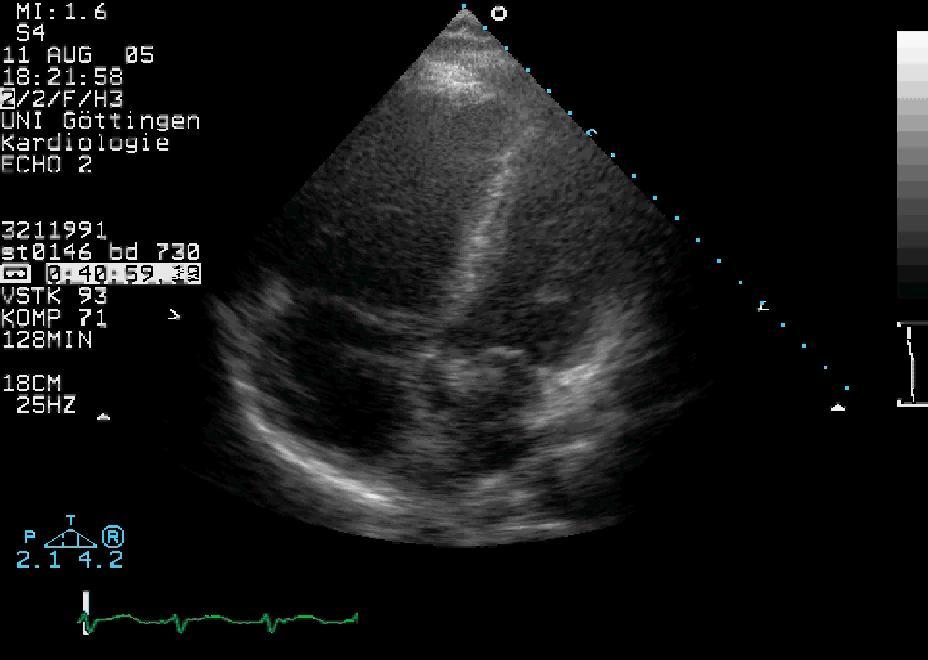 Echocardiographic findings in acute PE Echo criteria RV dilatation (RV>LV, or RVEDD >30 mm) RV free wall hypokinesia Paradoxical septal wall