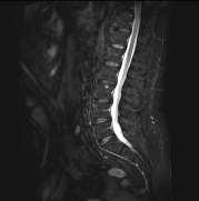 lumbar spine T1w