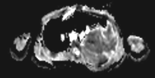 PET/MRI: diffusion imaging Diffusion ADC map Ewing sarcoma,