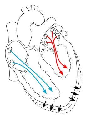 resulting in an increase in contractile force resulting in an increase in stroke volume. This is the basis of the Frank-Starling law of the heart.