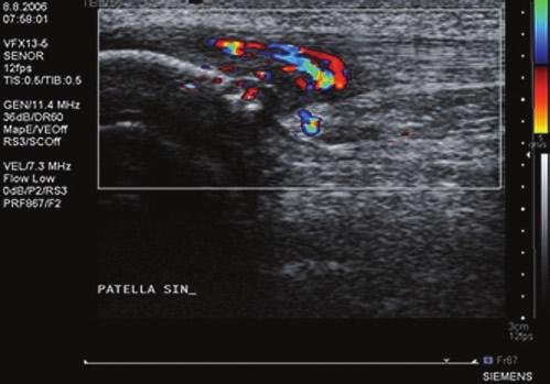 All tendons were examined with high resolution grey-scale ultrasound and with colour Doppler (Acuson Antares Sonoline, Capio Artro Clinic, Stockholm, Sweden ). A WSX 13-5 linear multifrequency (7 11.