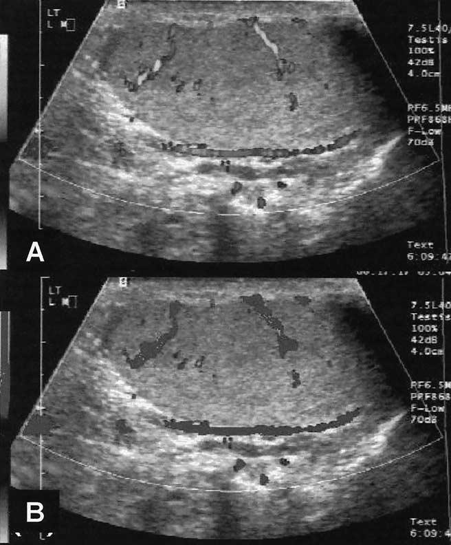 FIGURE 1 (A) Power Doppler ultrasound image of an azoospermic patient and (B) the processed image.