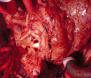 256 Color Atlas of Congenital Heart Surgery right ventricle outflow tract aortic valve FIGUE 14-22.