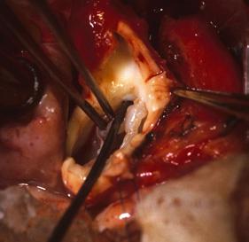 14 Valvular Stenosis 261 stenosing ring orifice of left coronary artery aortic valve cusp FIGUE 14-32.