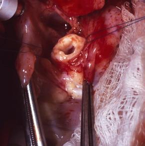 14 Valvular Stenosis 263 distal ascending aorta stenosing ring FIGUE 14-36.