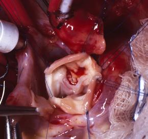 264 Color Atlas of Congenital Heart Surgery homograft patches aortic valve leaflets FIGUE 14-38.