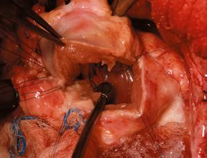 orifices. The posterior graft commissure is also attached to the posterior native aorta. The anterior wall of the autograft is stitched to the opening in the native aorta.