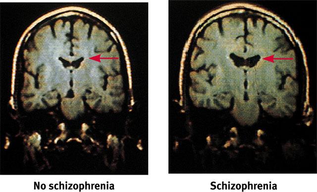 Abnormal Brain Scans Schizophrenia patients may exhibit changes in brain enlargement of