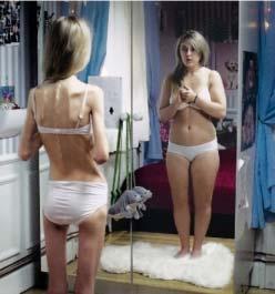 Eating disorders Anorexia starving