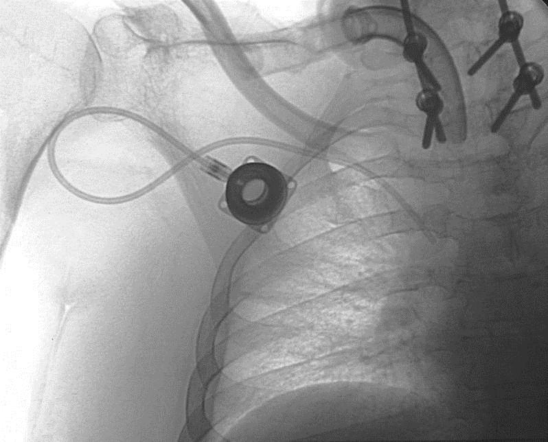 if port has flipped in pocket Port catheters