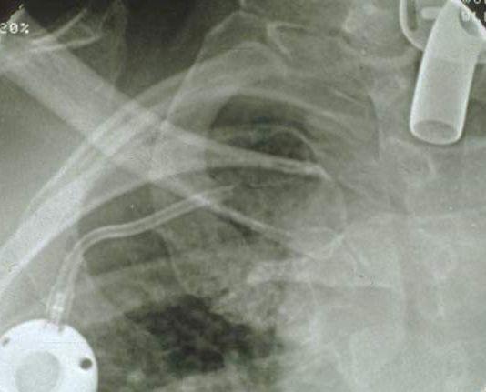 catheter due to Pinch-Off