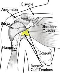 Rotator Cuff Tears Page ( 1 ) A rotator cuff tear is a common cause of pain and disability among adults.