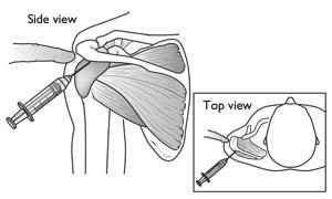 Page ( 4 ) do not show the soft tissues of your shoulder like the rotator cuff, plain x-rays of a shoulder with rotator cuff pain are usually normal or may show a small bone spur.