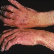 Occupational contact dermatitis Allergic contact