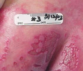 secondary cutaneous infections Allow skin to heal or
