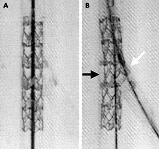 SB Ballooning in 1-Stent Technique Pros Scaffolding of SB ostium Access to SB preserved Correct distal stent sizing Optimizing proximal stent