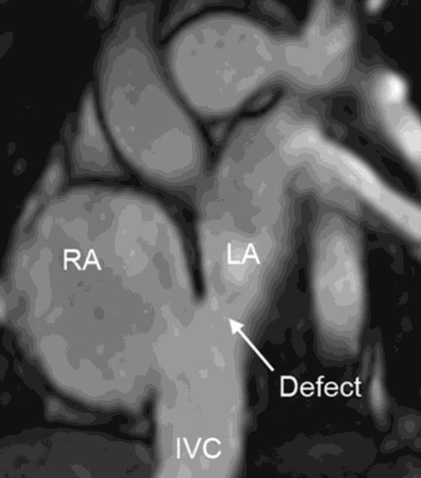 Inferior Sinus venosus ASD Very rare & difficult to diagnose Unexplained volume overload of right sided chambers should prompt for careful evaluation for: sinus venosus type of ASDs (superior or