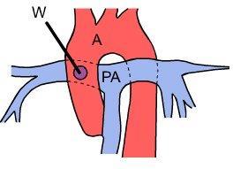 Interposition Goretex graft between SCA and PA Waterson shunt: Ascending