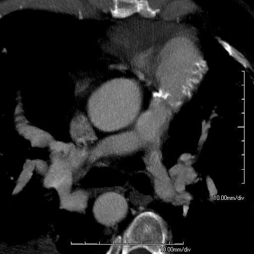 pulmonary artery and branches Detect RV enlargement