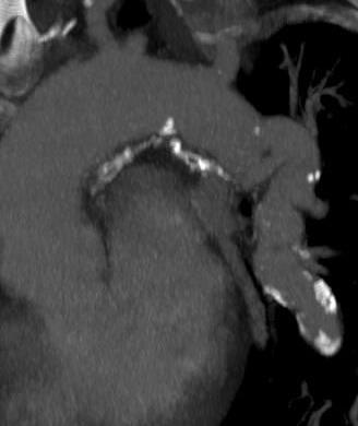 artery anomalies Case Study: 33 Y/M, repaired TOF