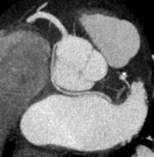 arrythymia or SOB CT may be done to evaluate post operative