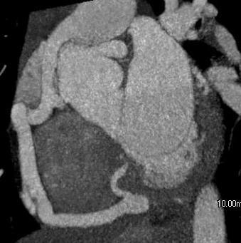Anomalous origin of RCA from pulmonary artery (ARCAPA) A rare