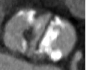 Potential Problems in Bicuspids Often heavily calcified - Incomplete valve expansion - Paravalvar leak - Annulus rupture Frequently associated with ascending aortic aneurysm - Risk of
