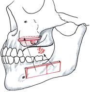 Fig 9 Schematic illustration of sinus grafting with bone from the lateral side of the mandible. Maxilla (with Grafting from the Lateral Mandible).