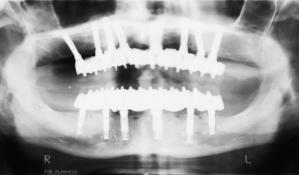 Fig 10 Panoramic radiograph of a patient with immediate prosthesis connection after placement of implants in both arches.