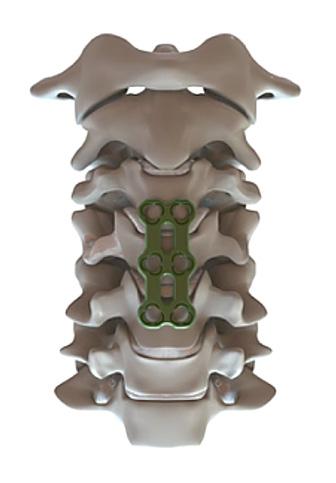 Surgical Technique Step One: Anterior Cervical Discectomy and Fusion (Fig.1) The disc excision is performed using standard surgical technique.