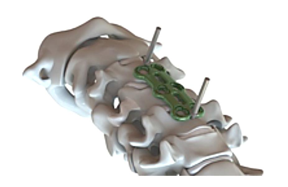 Bone grafts must be placed in the area to be fused and the graft must be extended from the upper to the lower vertebrae to be fused. Step Two: Selection and Bending of Plate (Fig.