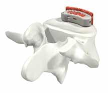 Centering Pin Optional Anterior graft Bone graft can be