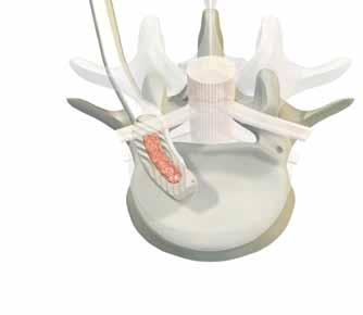 Implant insertion Step 8 Implant insertion Insert implant loaded with bone graft into the