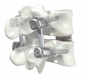 Stabilization/compression and removal or revision Step 11 Stabilization and compression Once the ROI-T implant is in situ, compress the segment via the posterior screws and rod to stabilize the ROI-T.