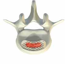 TLIF approach Utilize a standard operating instrument like a Kocher to grab or turn the implant.