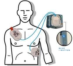 5 Using the Automated External Defibrillator 1. Open the AED. It will unzip or unfold similar to a lunchbox Figure 3: Example AED opened and ready for use. 2.